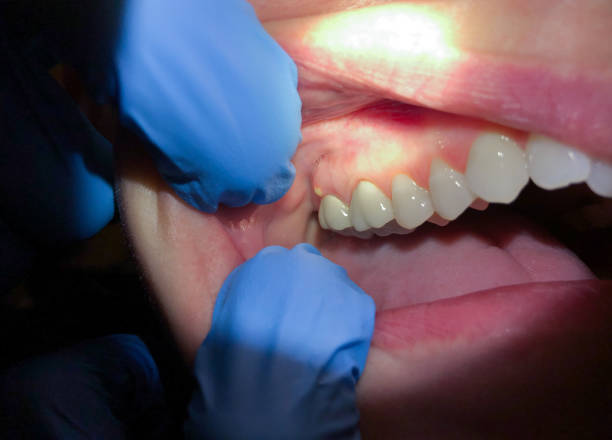 Best Dental Abscess Treatment in Wakeman, OH